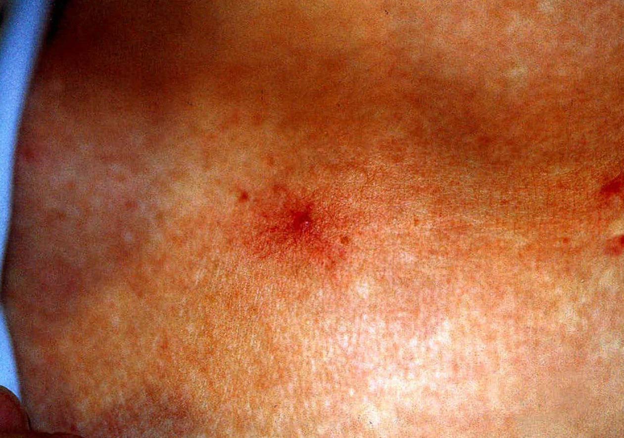 皮肤出现“红痣”是怎么回事？医生：多半与这一疾病有关，需警惕|蜘蛛痣|雌激素|肝脏_新浪新闻